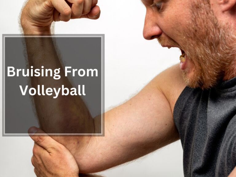 Bruising From Volleyball – Causes, Treatment, and Prevention
